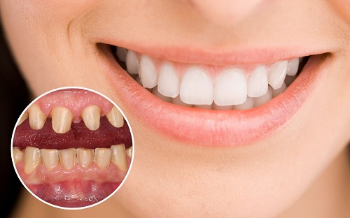 Chuyên gia giải đáp tất tần tật các thắc mắc về bọc răng sứ