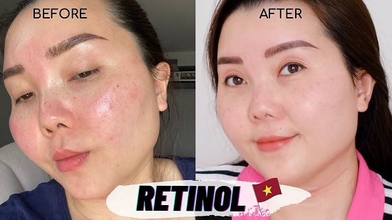 5 sự thật về Retinol Twins Skin và review tất tần tật sau khi sử dụng